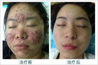 华肤双11“战痘节”：我与美丽有个约惠